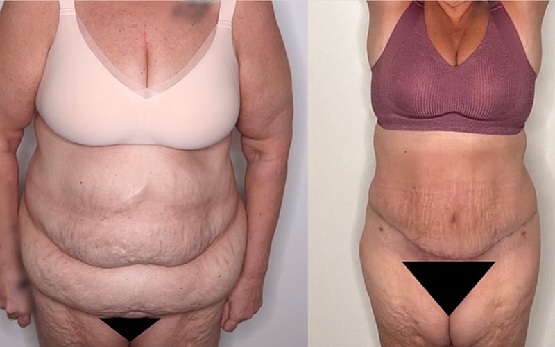 Before and after body transformation comparison image