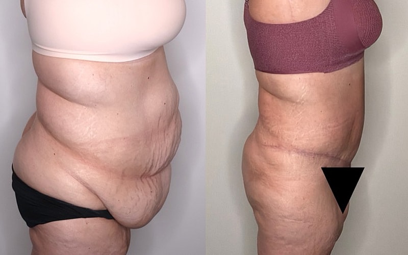 Post-surgery body comparison, before and after.