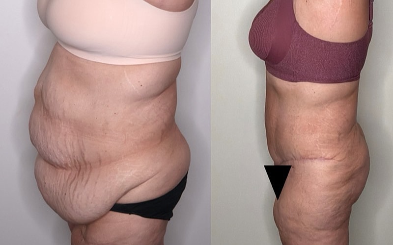 Before and after body composition comparison.
