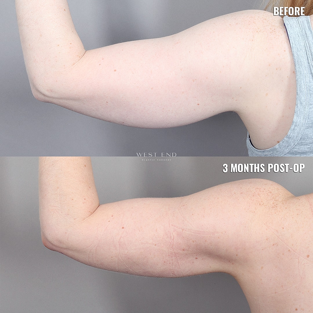 Before and after arm transformation post-surgery.