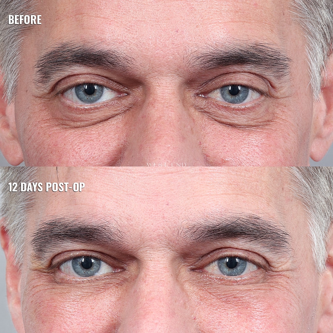 Before and after eyelid surgery comparison image.