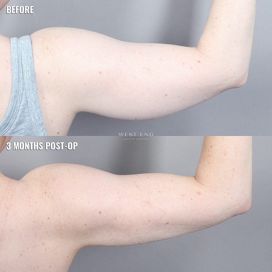 Arm transformation before and after surgery.