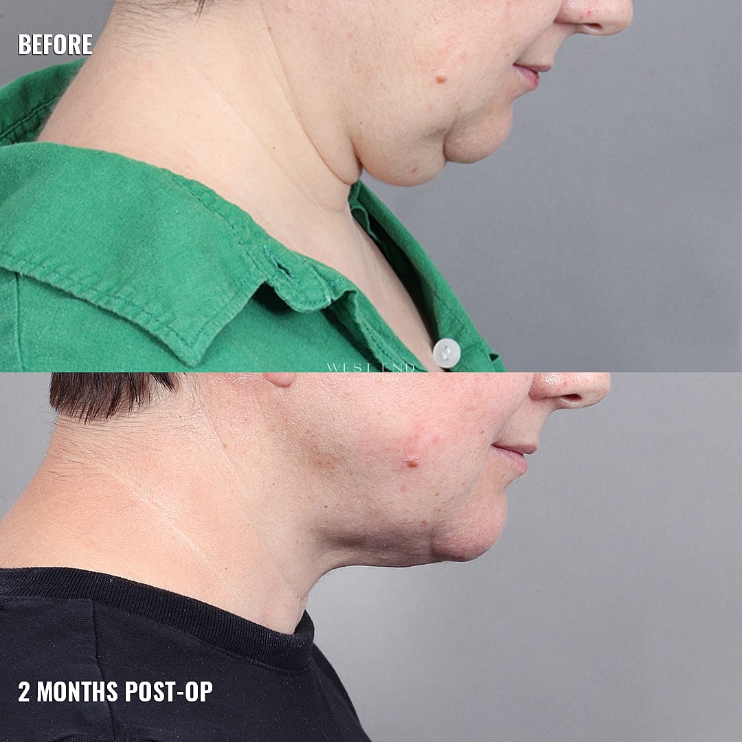 Before and after chin surgery comparison image