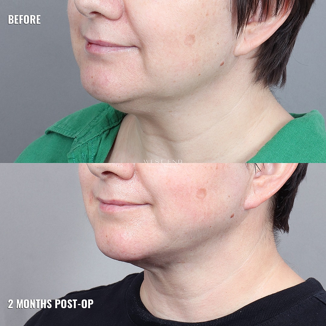 Before and after cosmetic procedure comparison.