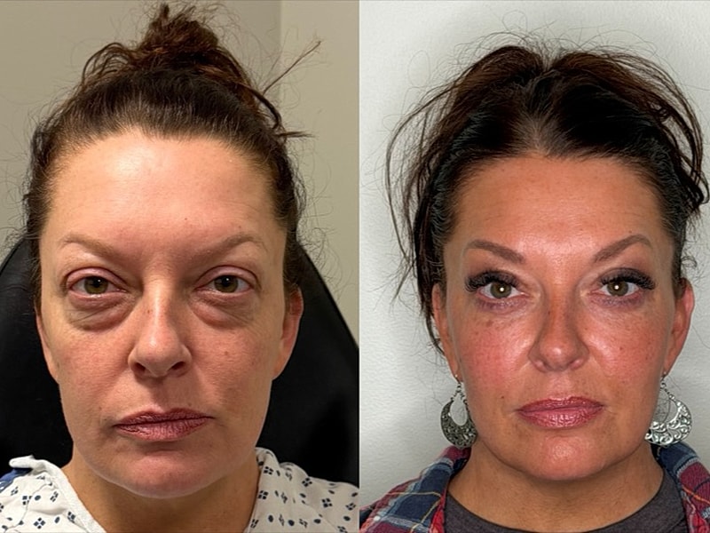 Before and after facial treatment comparison.