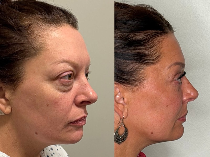 Before and after cosmetic treatment side profile comparison