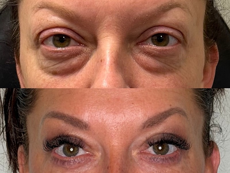 Before and after eyelash enhancement transformation.