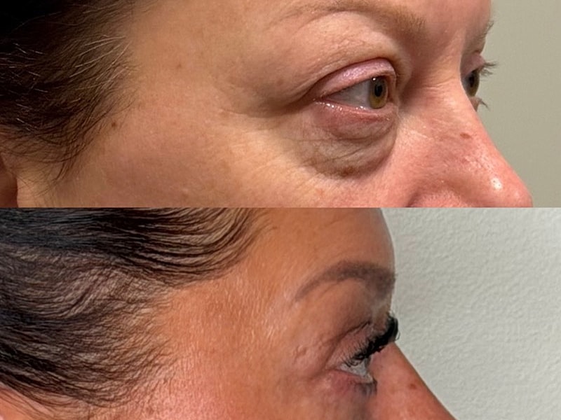 Before and after eye treatment comparison