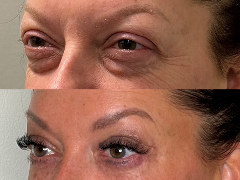 Before and after eyelash enhancement treatment.
