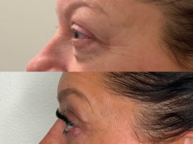 Before and after eye treatment comparison.