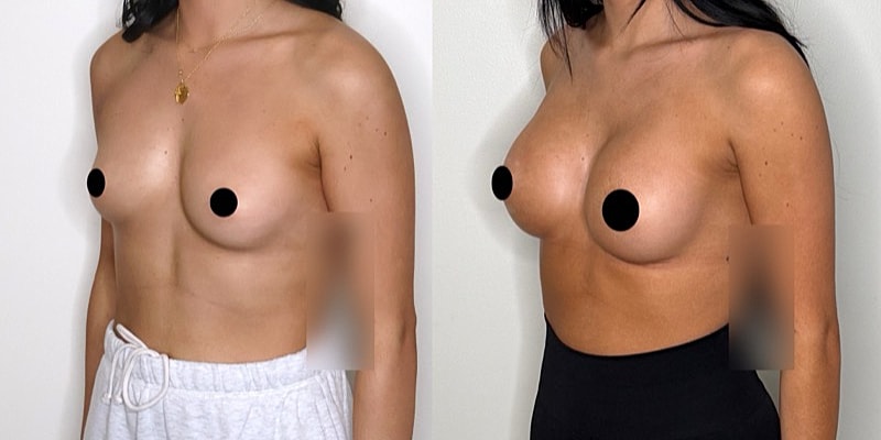 Breast augmentation before and after comparison.