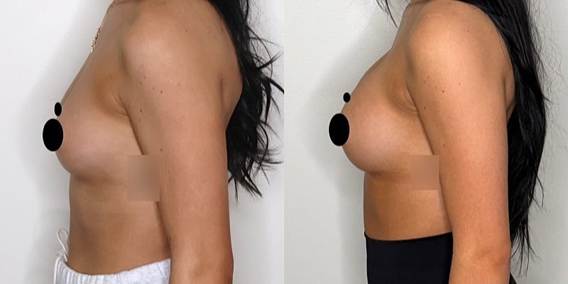 Before and after breast augmentation comparison.
