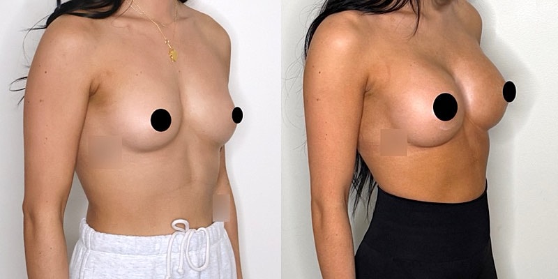 Before and after images of breast augmentation.
