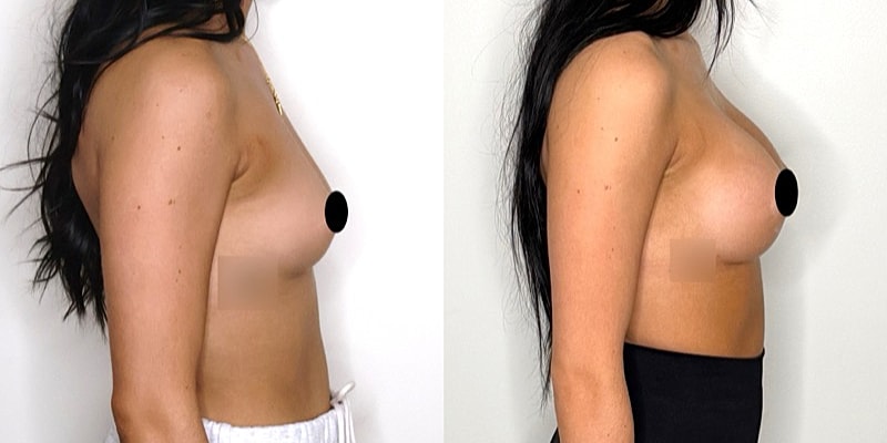 Before and after breast augmentation side profile comparison.