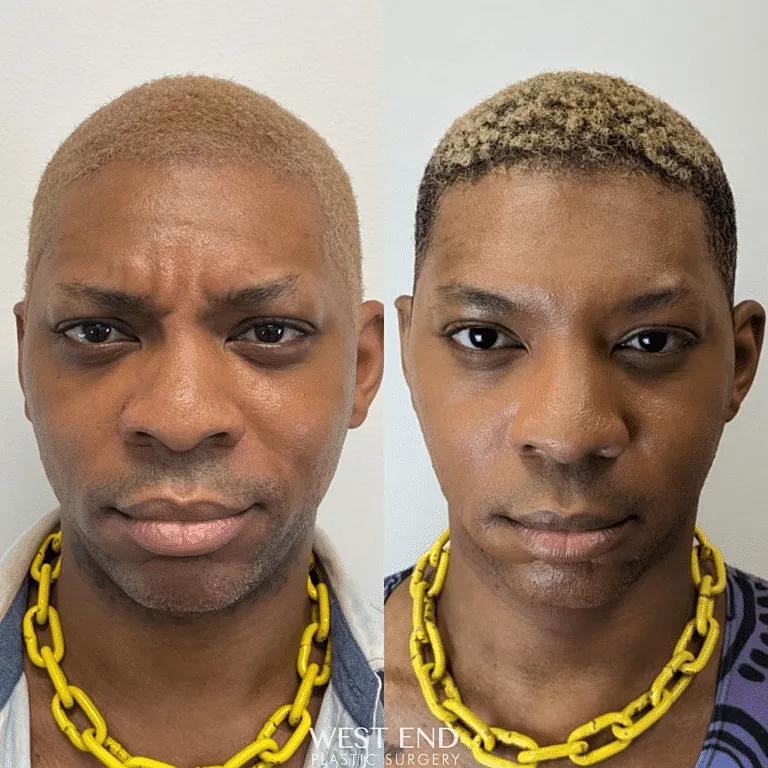before and after dysport filler treatment Washington DC