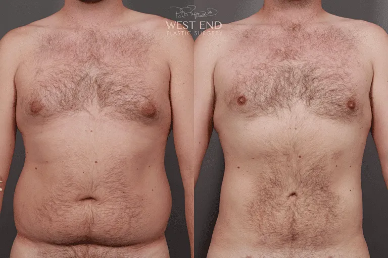 Before and after plastic surgery transformation photo.