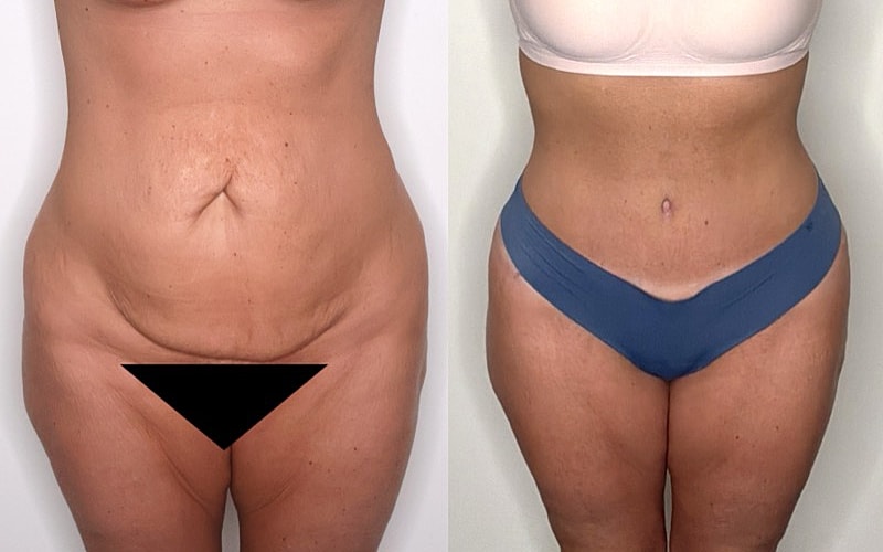 Before and after body transformation comparison.