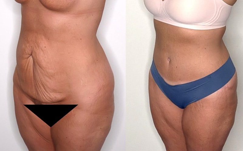 Before and after body transformation comparison.