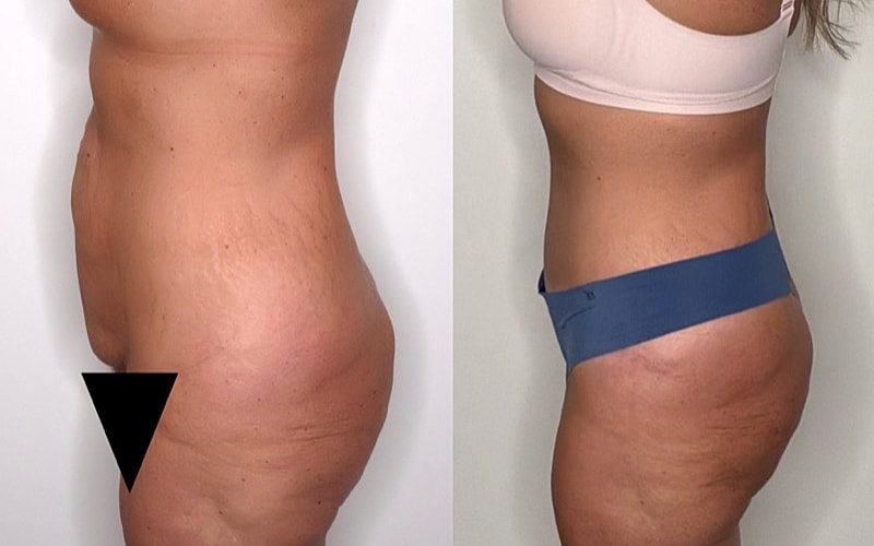 Before and after body shape comparison image