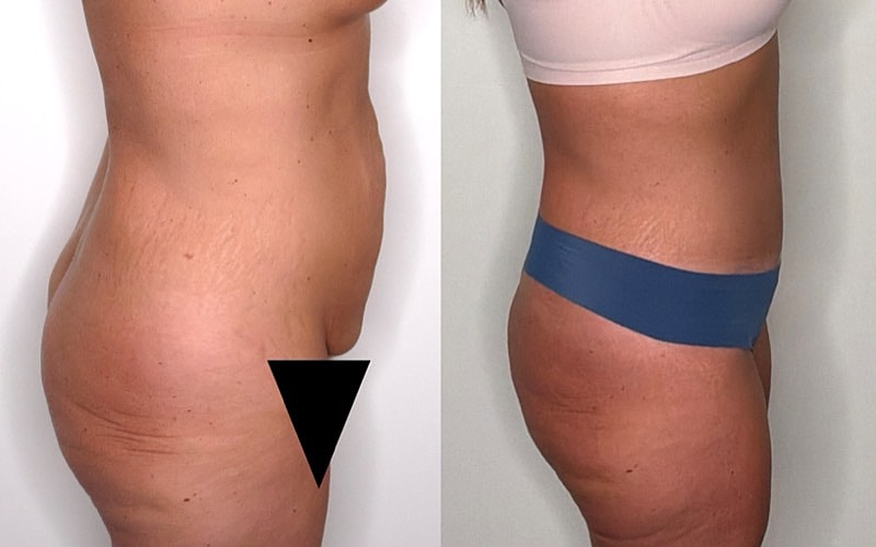 Comparison of body appearance before and after.