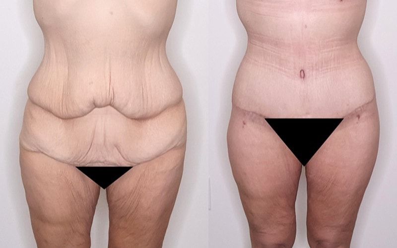 Before and after body transformation comparison image.