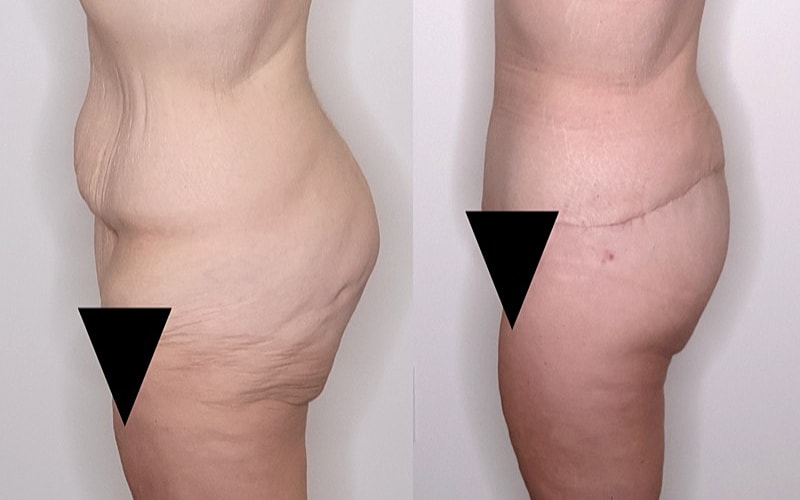 Before and after body contouring results.