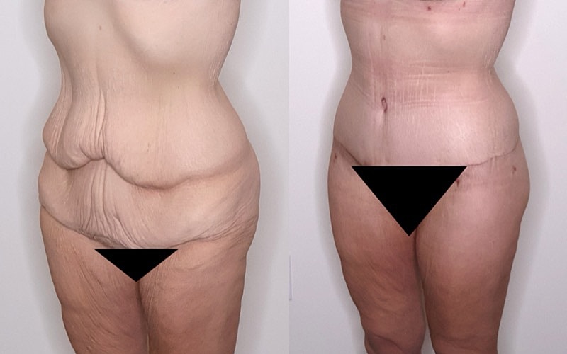 Body transformation before and after comparison.