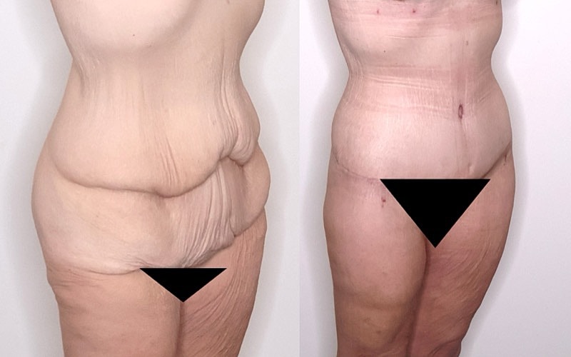 Before and after body transformation comparison.