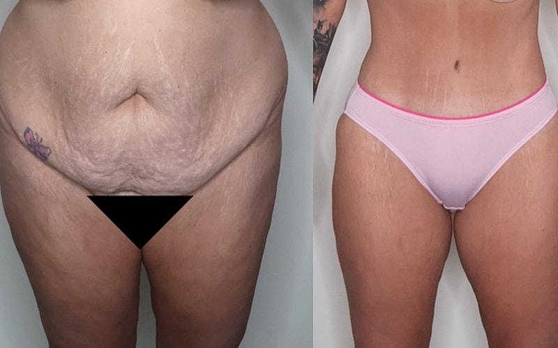 Comparison of body changes and stretch marks.