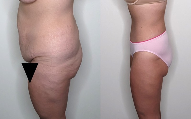 Before and after body transformation comparison.
