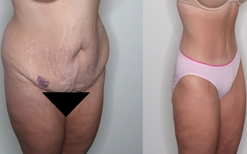 Before and after body transformation comparison