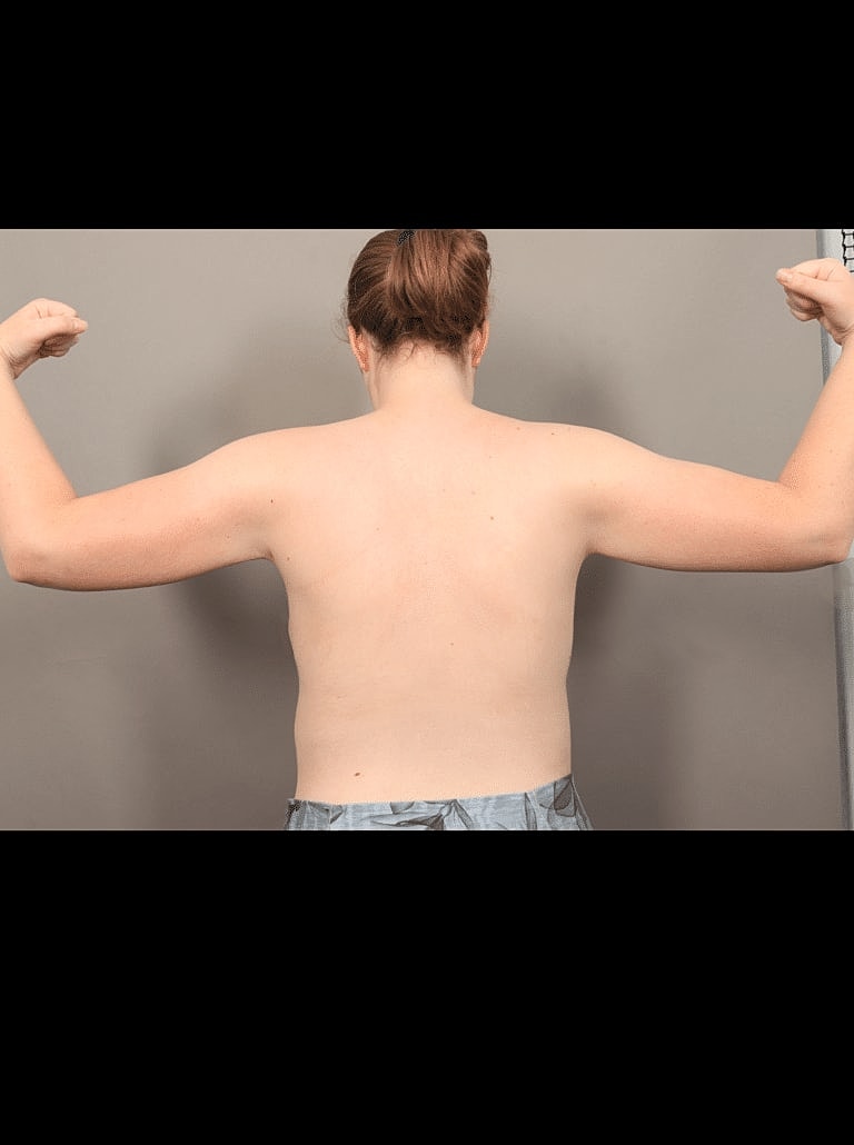 Renuvion Before & After