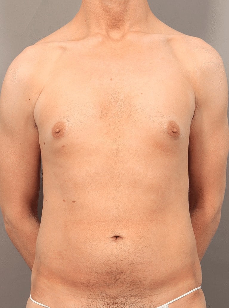 Renuvion Before & After