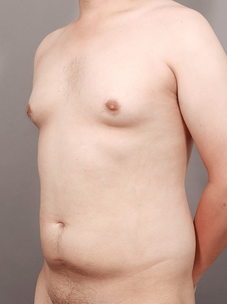 Renuvion Before & After