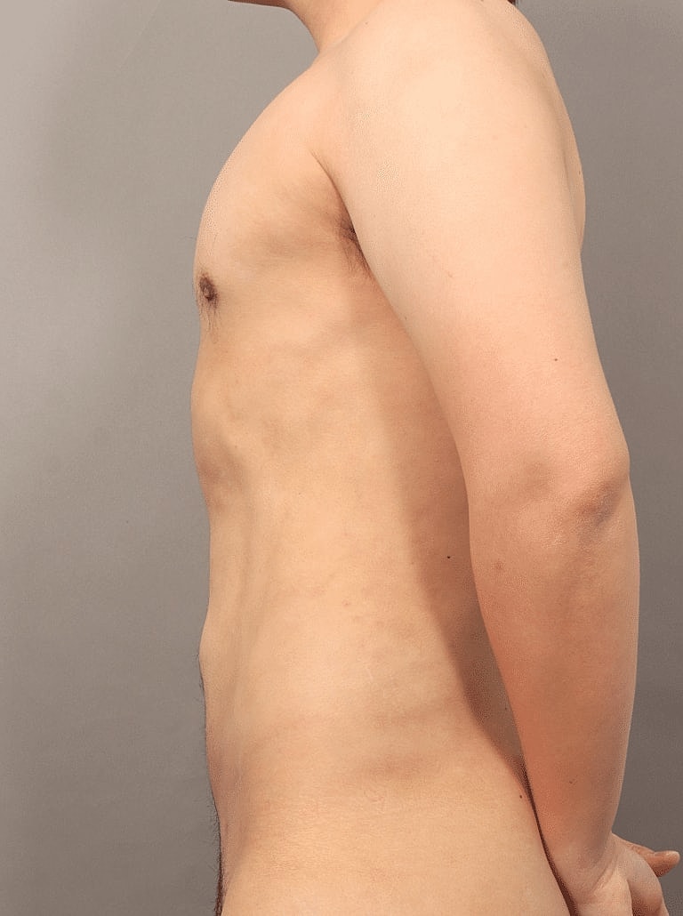 Renuvion Before & After