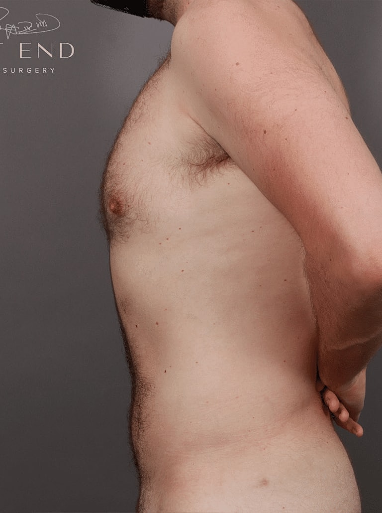 Renuvion Before & After
