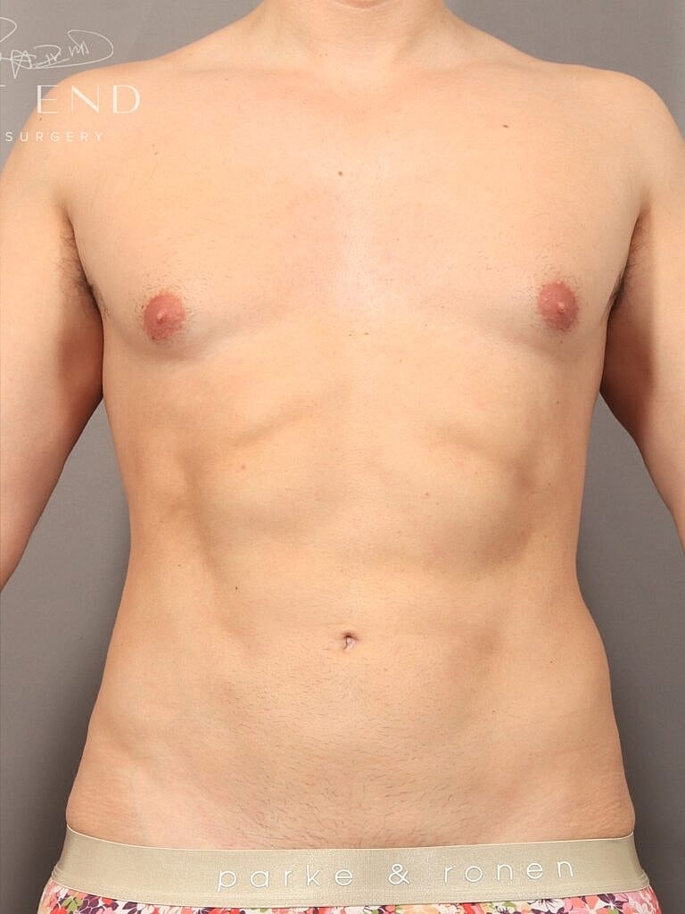 Renuvion Before & After