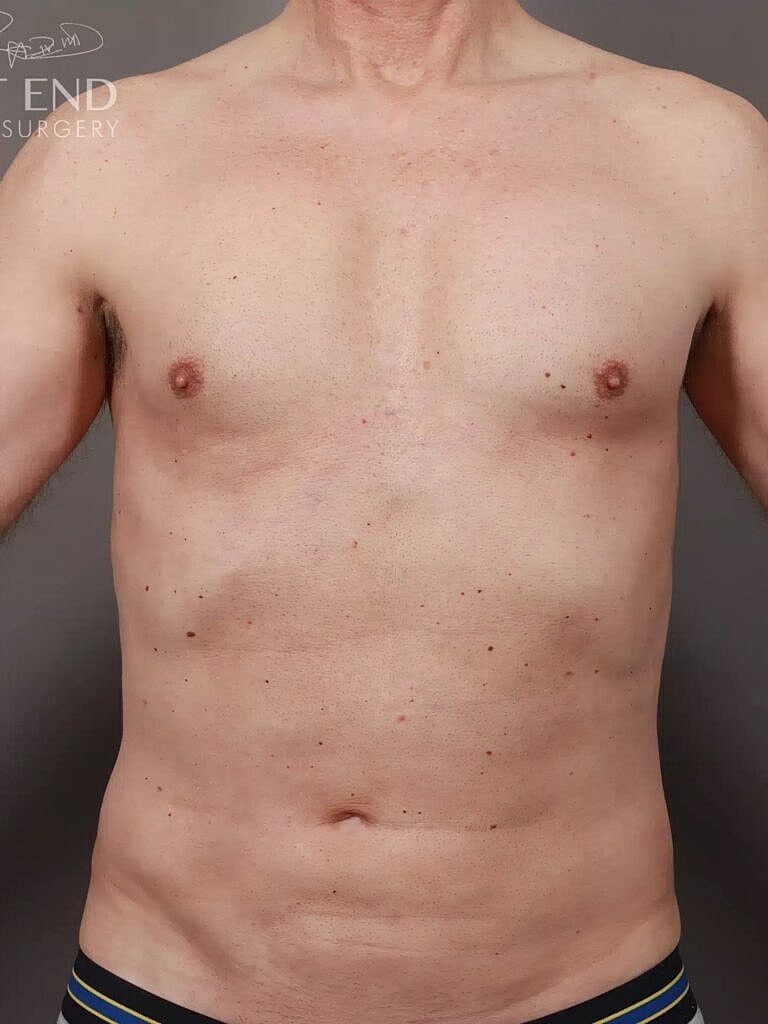 Renuvion Before & After