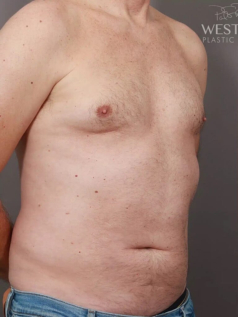 Renuvion Before & After