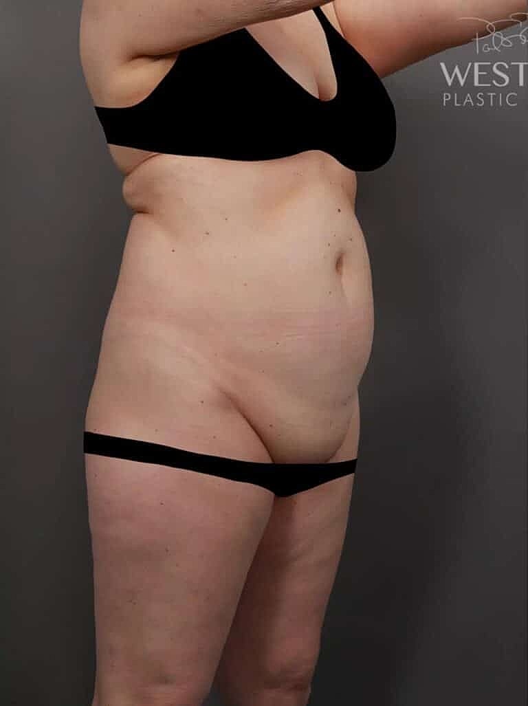 Renuvion Before & After
