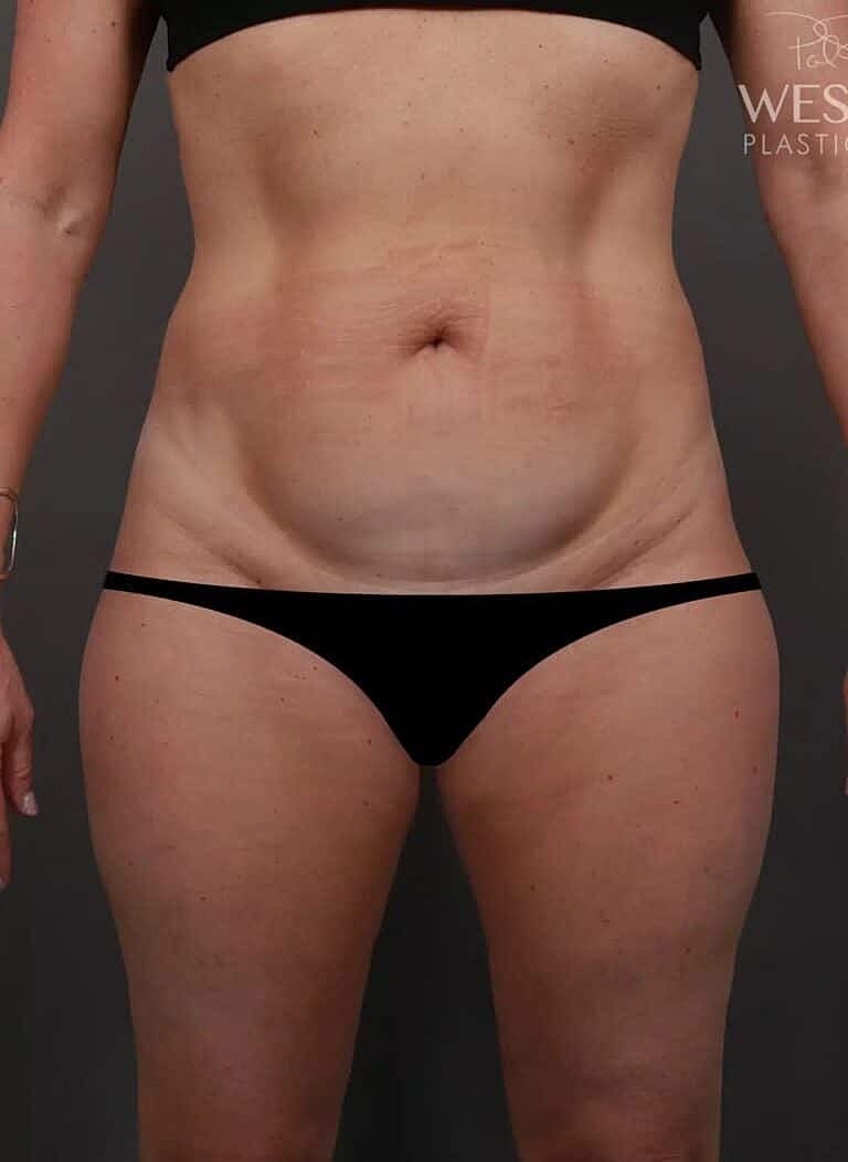 Renuvion Before & After