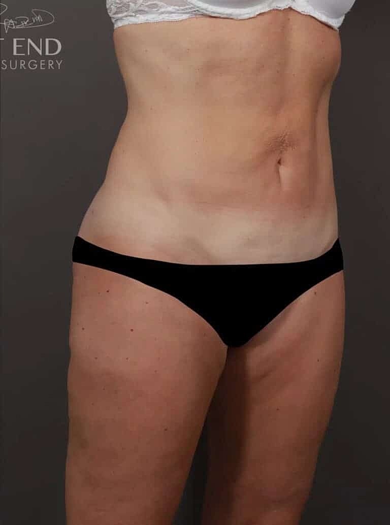 Renuvion Before & After