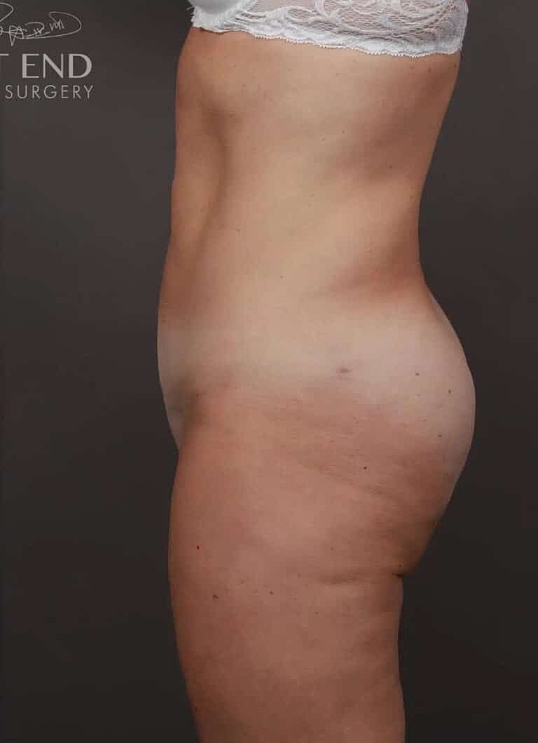 Renuvion Before & After