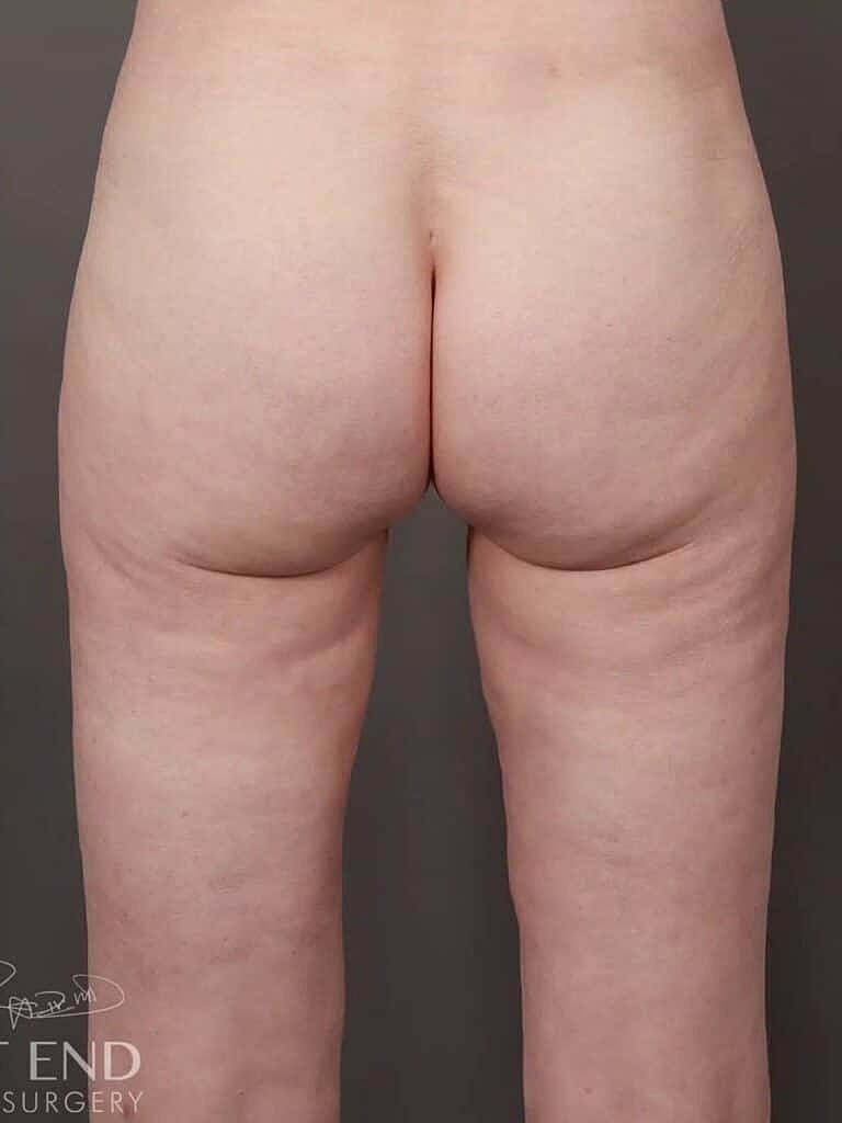 Renuvion Before & After