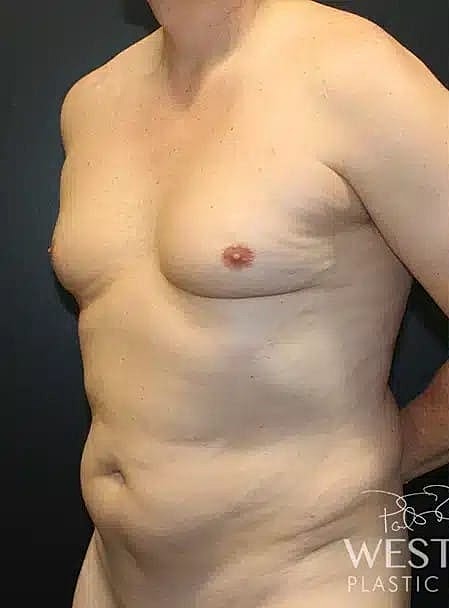 Renuvion Before & After