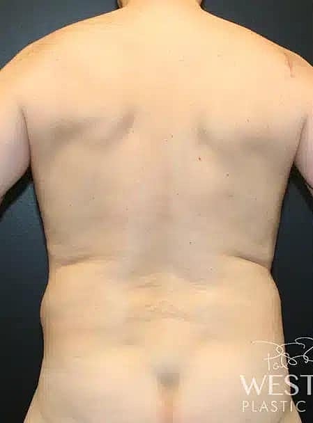 Renuvion Before & After