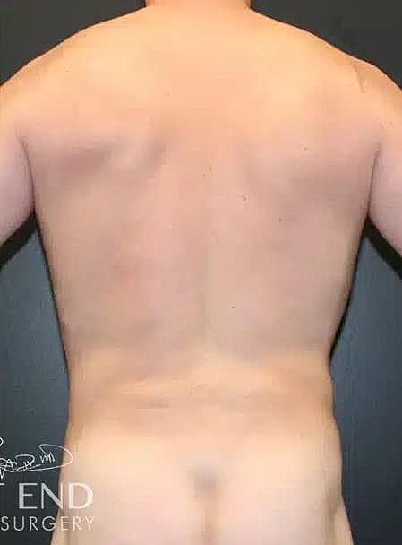 Renuvion Before & After