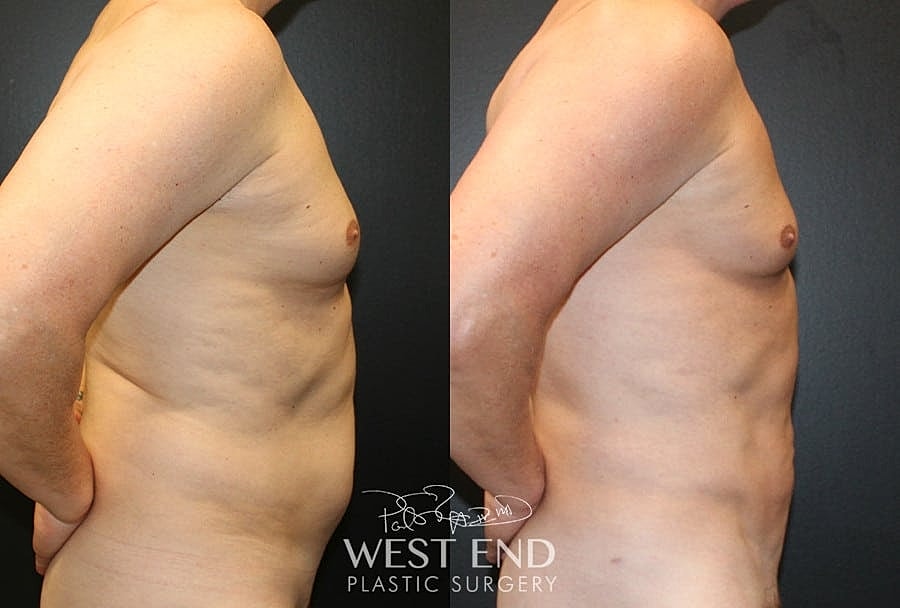 Renuvion Before & After