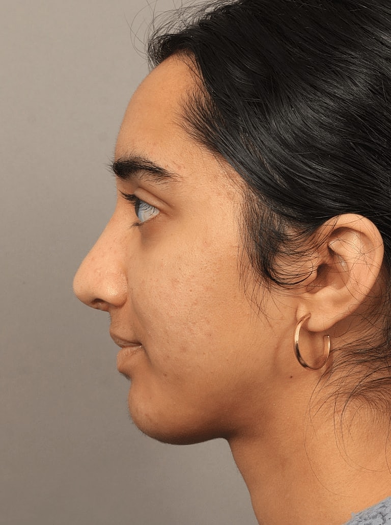 Alarplasty Nostril Reduction Before & After