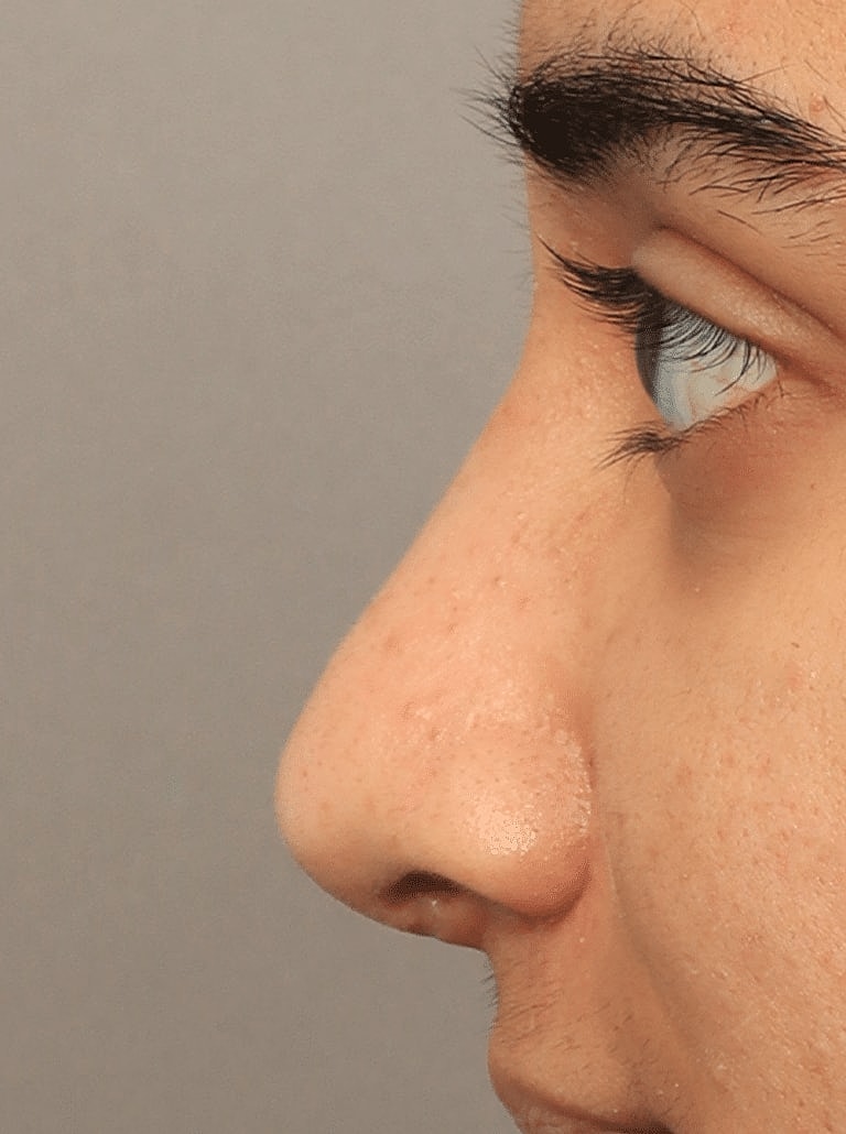 Alarplasty Nostril Reduction Before & After